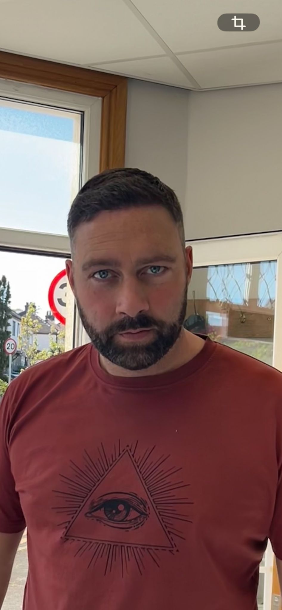 Anthony 6-month hairline and temple restoration