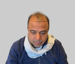 Before hair transplant