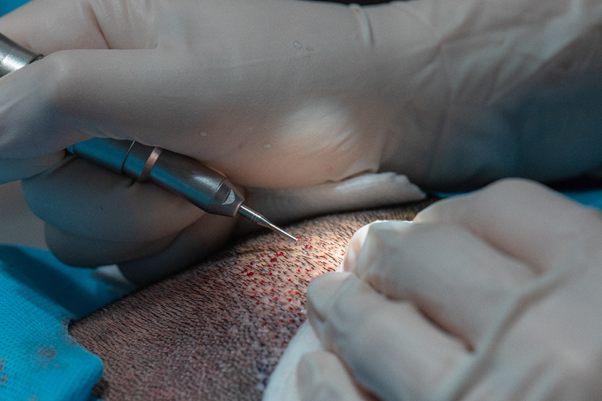 FUE Hair Transplant Procedure at Monarch Clinic Chester