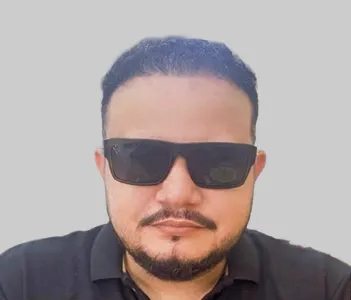 After FUE hair transplant results Chester UK - Ali full transformation