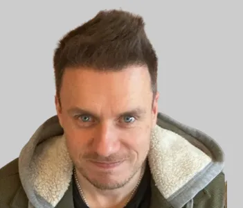 After hair transplant results Chester UK - Patient 8 temple restoration