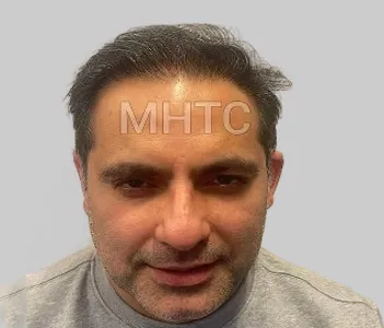 After DHI hair restoration results Chester Cheshire - Patient 6 density improvement