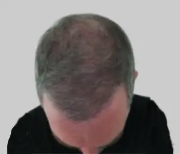 After FUE hair transplant results Chester Cheshire UK - Patient 10 full coverage