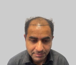 Before DHI hair transplant Chester Cheshire - Patient 2 hairline