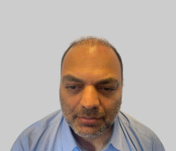 Before FUE hair transplant Chester - Patient 3 crown hair loss