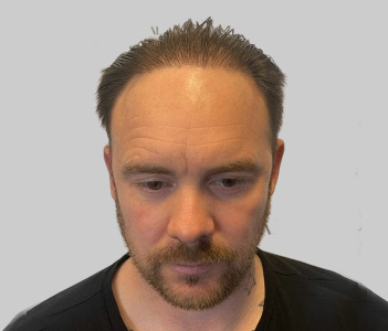 Before FUE hair transplant Chester Cheshire - Patient 7 male pattern baldness