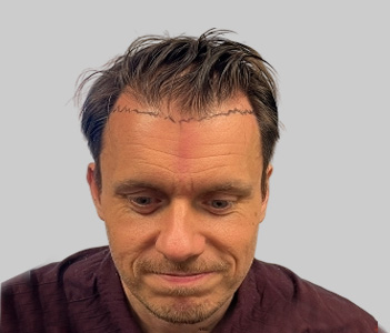 Before hair transplant Chester UK - Patient 8 temple hair loss
